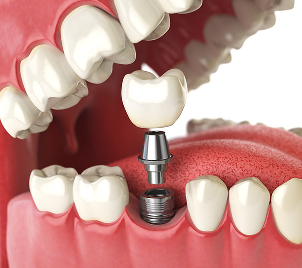 Gainesville Will I Need a Bone Graft for Dental Implants
