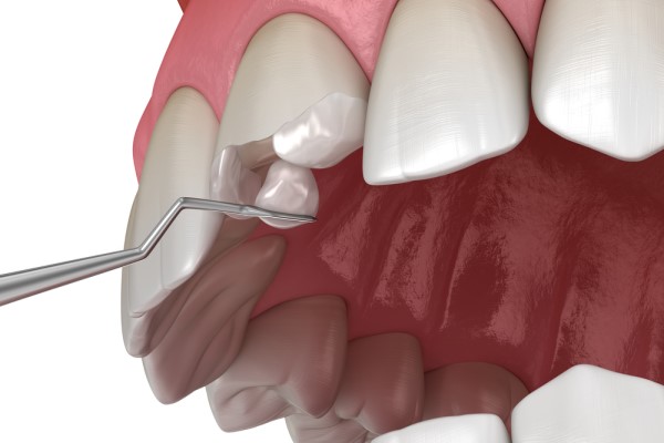 How Dental Fillings Can Fix A Broken Tooth
