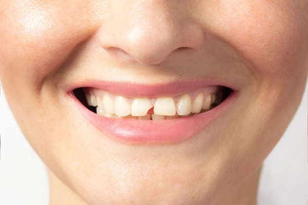 Reasons To Address A Chipped Tooth Immediately