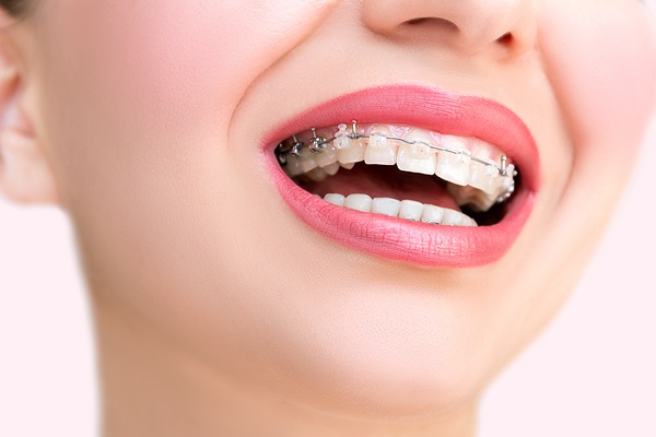 How To Maintain Your Oral Health With Clear Braces From A General Dentist