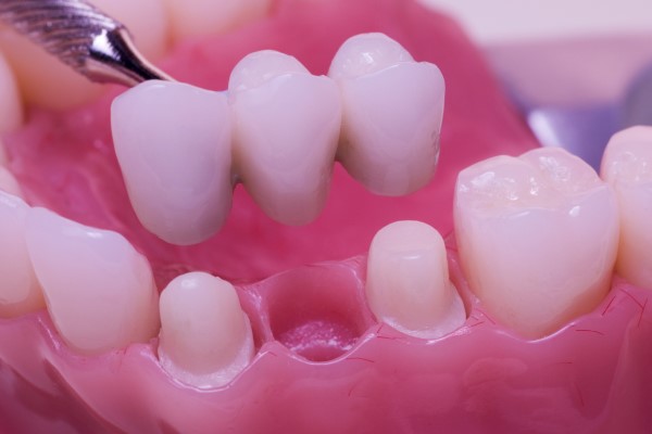 Can A Dental Bridge Replace Multiple Teeth?