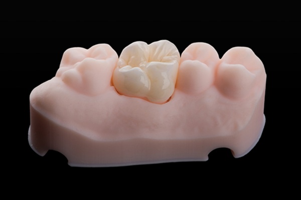 The Versatile Uses Of Dental Crowns