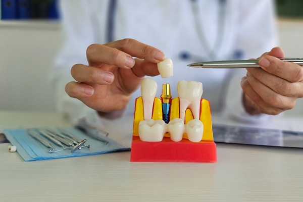 A Guide To Partial And Full Arch Dental Implants
