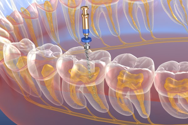Improve Your Oral Health With Endodontics Treatment