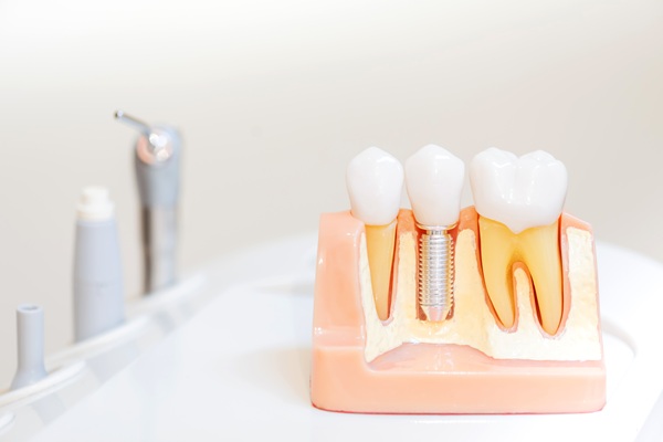 An Implant Dentist Discusses Bone Growth And Healing After Placement