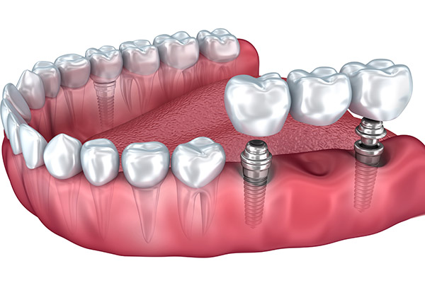 Implant Dentistry Options With Dental Bridges from Prince William Dental in Gainesville, VA