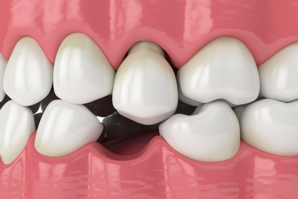Options For Replacing Missing Teeth To Give Yourself A Healthier Smile