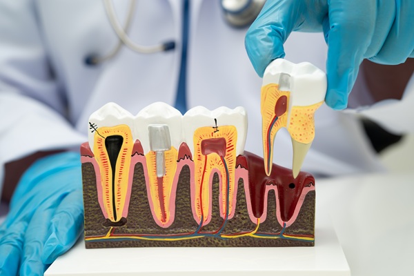 Debunking Root Canal Myths: How This Procedure Protects Oral Health
